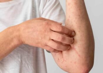 OPS: casos de sarampión en las Américas se multiplicaron por 34 con respecto a 2024