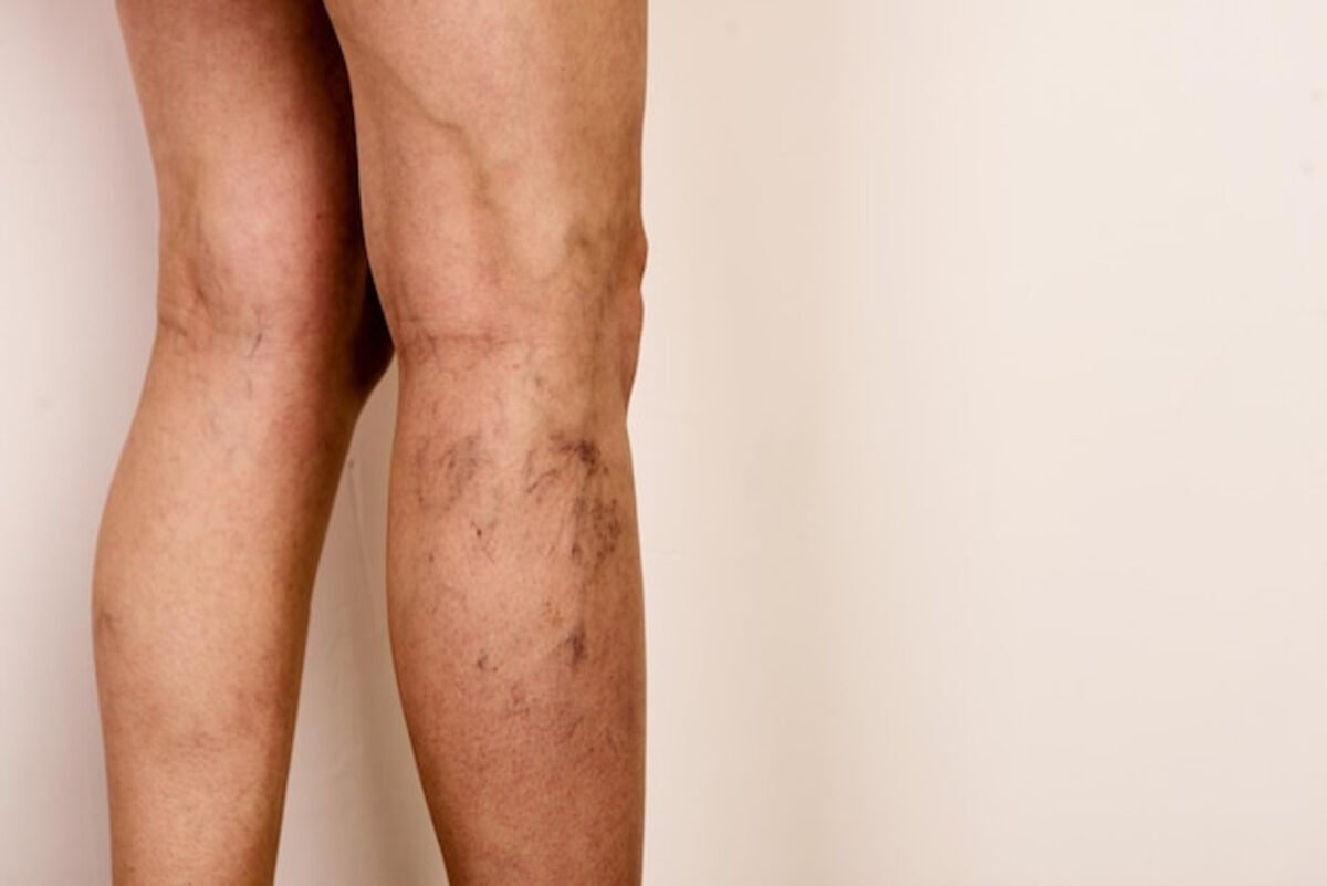 Varices vs. arañas vasculares: diferencias, síntomas y tratamiento